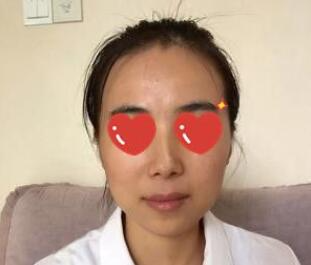 上海美萊醫(yī)生熊師做玻尿酸隆下巴怎么樣，熊師玻尿酸隆下巴案例分享