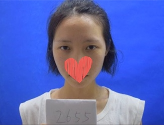 北京美萊整形專家杜園園開外眼角怎么樣？杜園園開外眼角案例效果對比圖