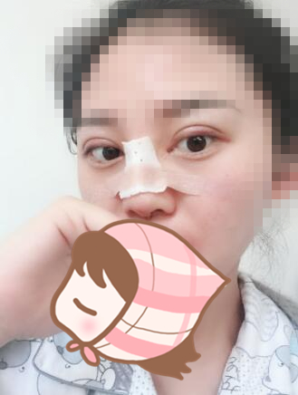 術后60天效果。