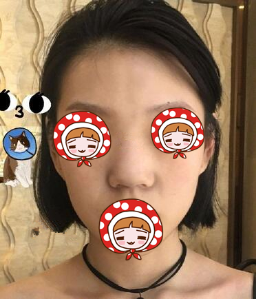 北京京韓醫(yī)療美容診所做硅膠隆鼻效果怎么樣？北京京韓醫(yī)療硅膠隆鼻案例