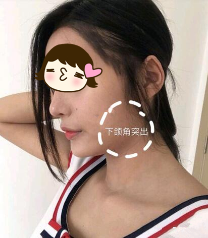 滄州瑞美醫(yī)療整形專家張鵬做下頜角磨骨整形技術(shù)怎么樣？附案例