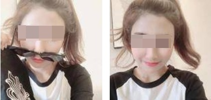 昆明麗都整形醫(yī)生孟春麗做面部自體脂肪填充效果怎么樣？