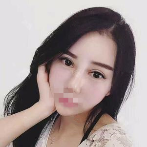 東莞維多利亞做硅膠隆鼻怎么樣？整形醫(yī)生李剛硅膠隆鼻案例分享
