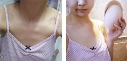 沈陽杏林整形美容醫(yī)院崔昌墉醫(yī)生做假體隆胸技術(shù)怎么樣？附案例
