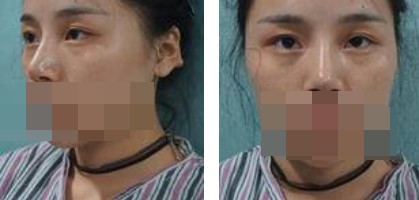 寧波美仁整形美容醫(yī)院李英大醫(yī)生做切開(kāi)雙眼皮效果怎么樣？