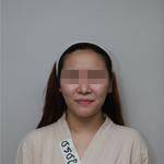 深圳尚虹醫(yī)療整形醫(yī)生藍(lán)劍雄做自體脂肪豐面頰效果怎么樣？附案例