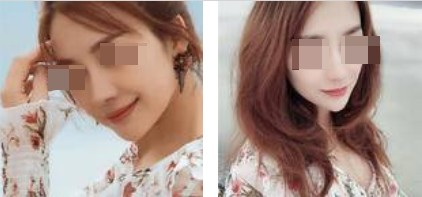 上海攸維醫(yī)療美容診所整形醫(yī)生李靜做膨體隆鼻效果怎么樣？附案例展示
