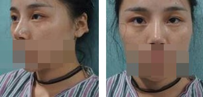 寧波美仁整形美容醫(yī)院李英大醫(yī)生做切開(kāi)雙眼皮效果怎么樣？