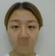 做了全切雙眼皮不僅外表變美了，內(nèi)心也更加自信了