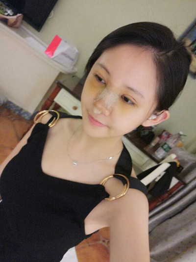 海南添美整形外科醫(yī)生王曉軍做自體軟骨隆鼻+雙眼皮+祛眼袋案例效果對(duì)比圖