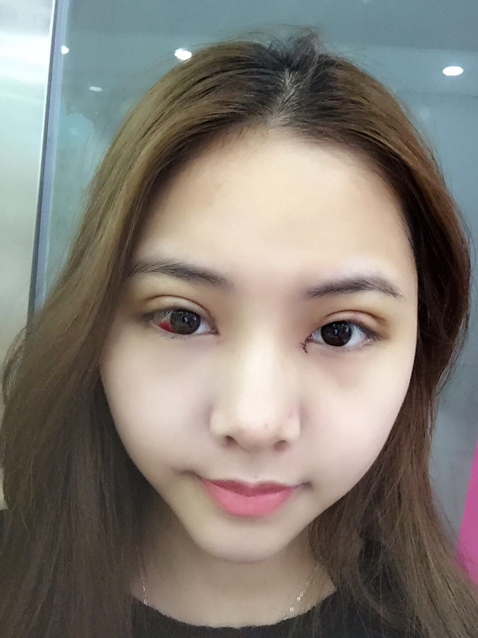 整形醫(yī)生徐長(zhǎng)亮做切開(kāi)雙眼皮案例效果對(duì)比圖