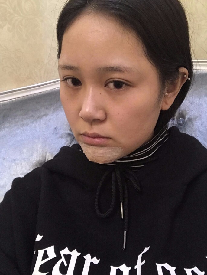 青島集美整形醫(yī)院做硅膠墊下巴怎么樣？趙煜楠醫(yī)生硅膠墊下巴真人案例