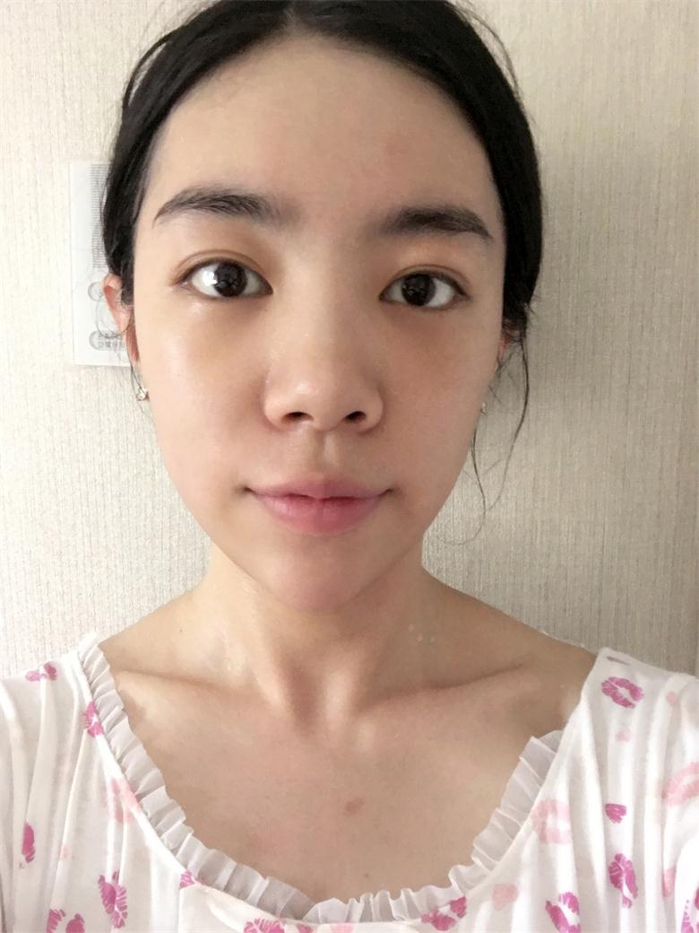 合肥壹加壹整形美容醫(yī)院做祛眼袋效果怎么樣？金大生祛眼袋案例分享