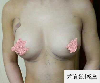 深圳博美整形醫(yī)生劉超做自體脂肪隆胸怎么樣？自體脂肪隆胸案例