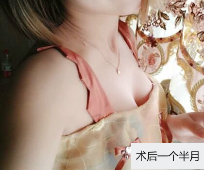 深圳博美整形醫(yī)生劉超做自體脂肪隆胸怎么樣？自體脂肪隆胸案例