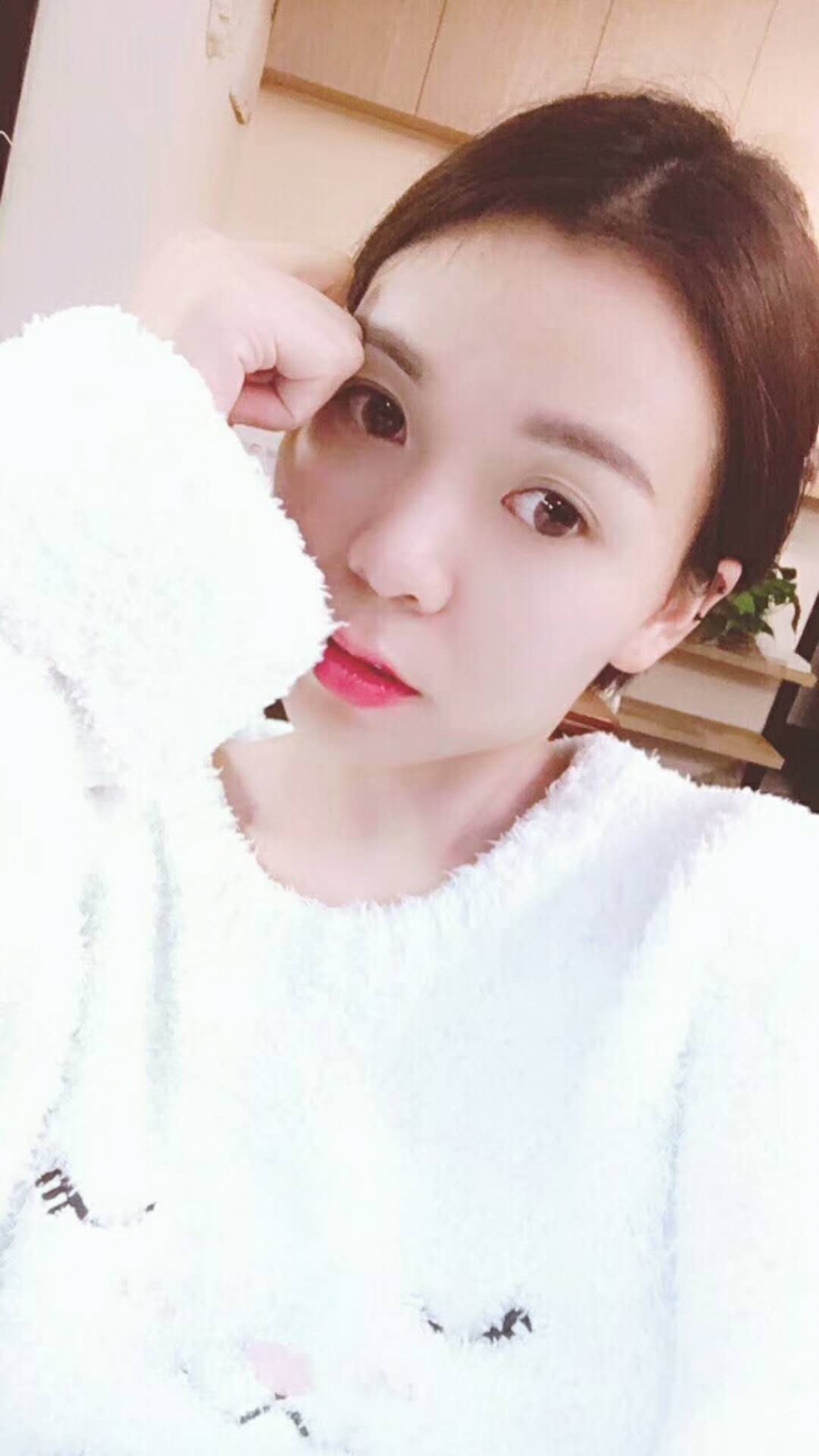 長沙星雅醫(yī)療美容醫(yī)院做埋線提升去法令紋效果怎么樣？附金振玉醫(yī)生案例
