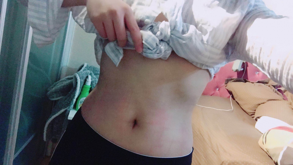 深圳晨曦整形醫(yī)院吉米斯做腰腹吸脂怎么樣？附吉米斯醫(yī)生腰腹吸脂案例