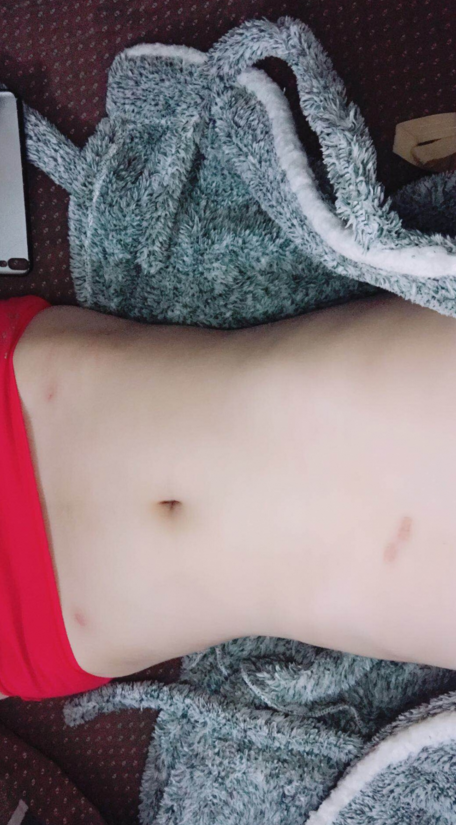 深圳晨曦整形醫(yī)院吉米斯做腰腹吸脂怎么樣？附吉米斯醫(yī)生腰腹吸脂案例