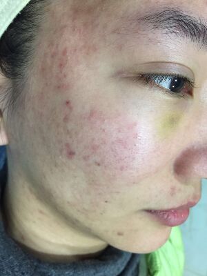 重慶柏漫醫(yī)療美容診所做激光祛痘效果怎么樣？白亞亞激光祛痘案例