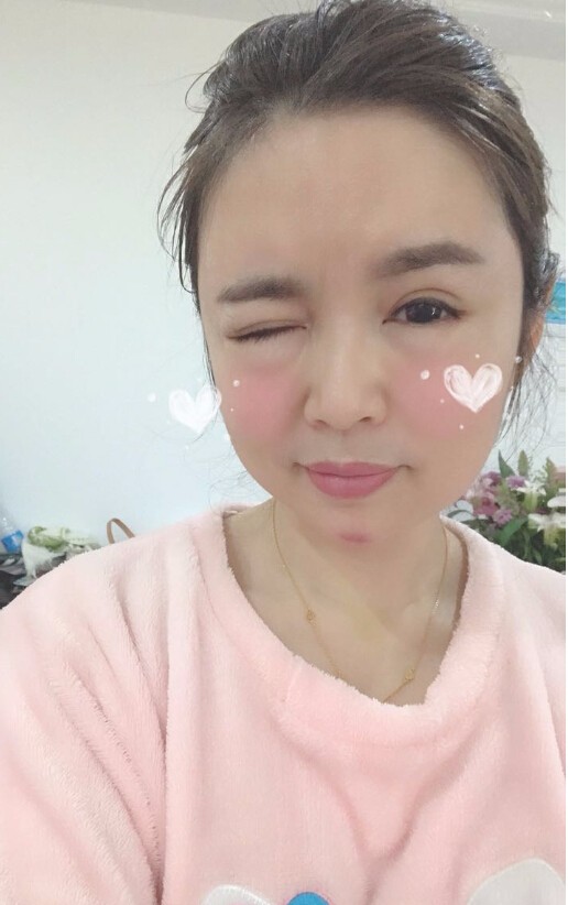 重慶聯(lián)合麗格美容醫(yī)院林麗蓉醫(yī)生做自體脂肪豐蘋果肌怎么樣？附案例