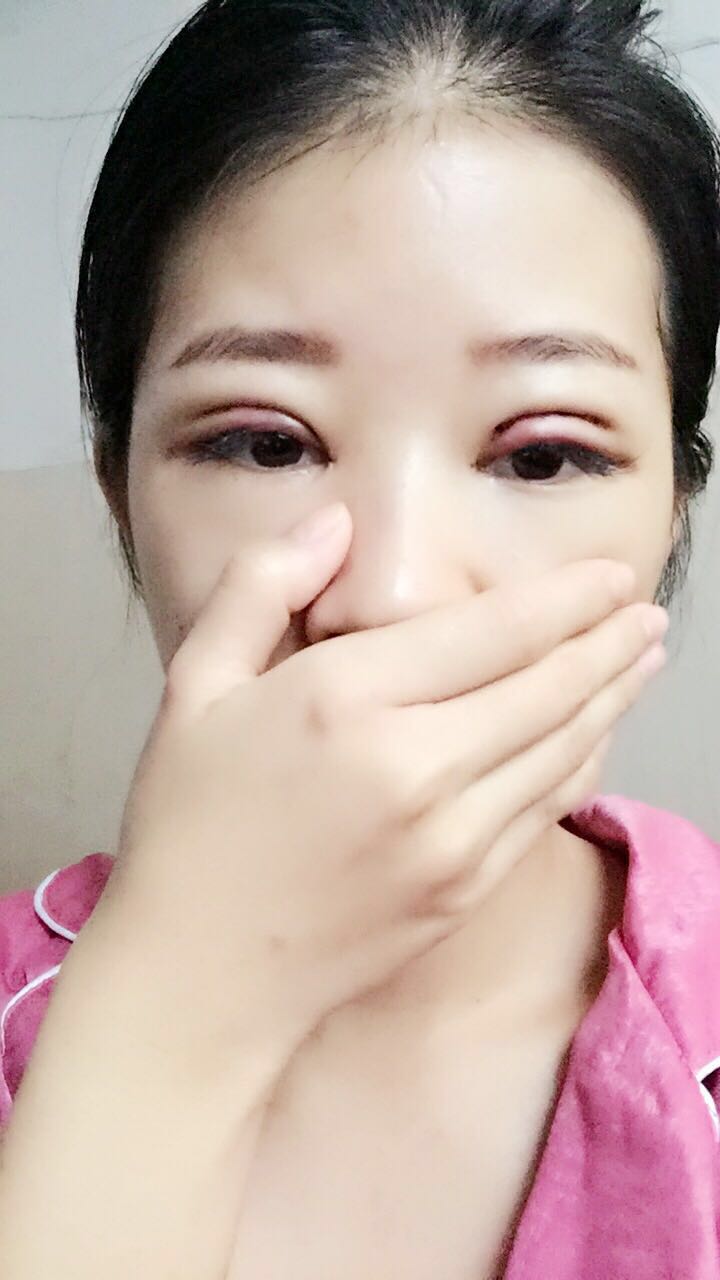 深圳晨曦醫(yī)療整形醫(yī)生吉米斯做切開雙眼皮怎么樣？吉米斯切開雙眼皮案例效果