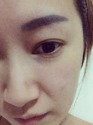 重慶五洲女子醫(yī)院整形美容中心做光子嫩膚怎么樣？淡明斌醫(yī)生光子嫩膚案例