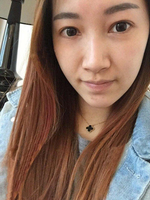 重慶五洲女子醫(yī)院整形美容中心做光子嫩膚怎么樣？淡明斌醫(yī)生光子嫩膚案例