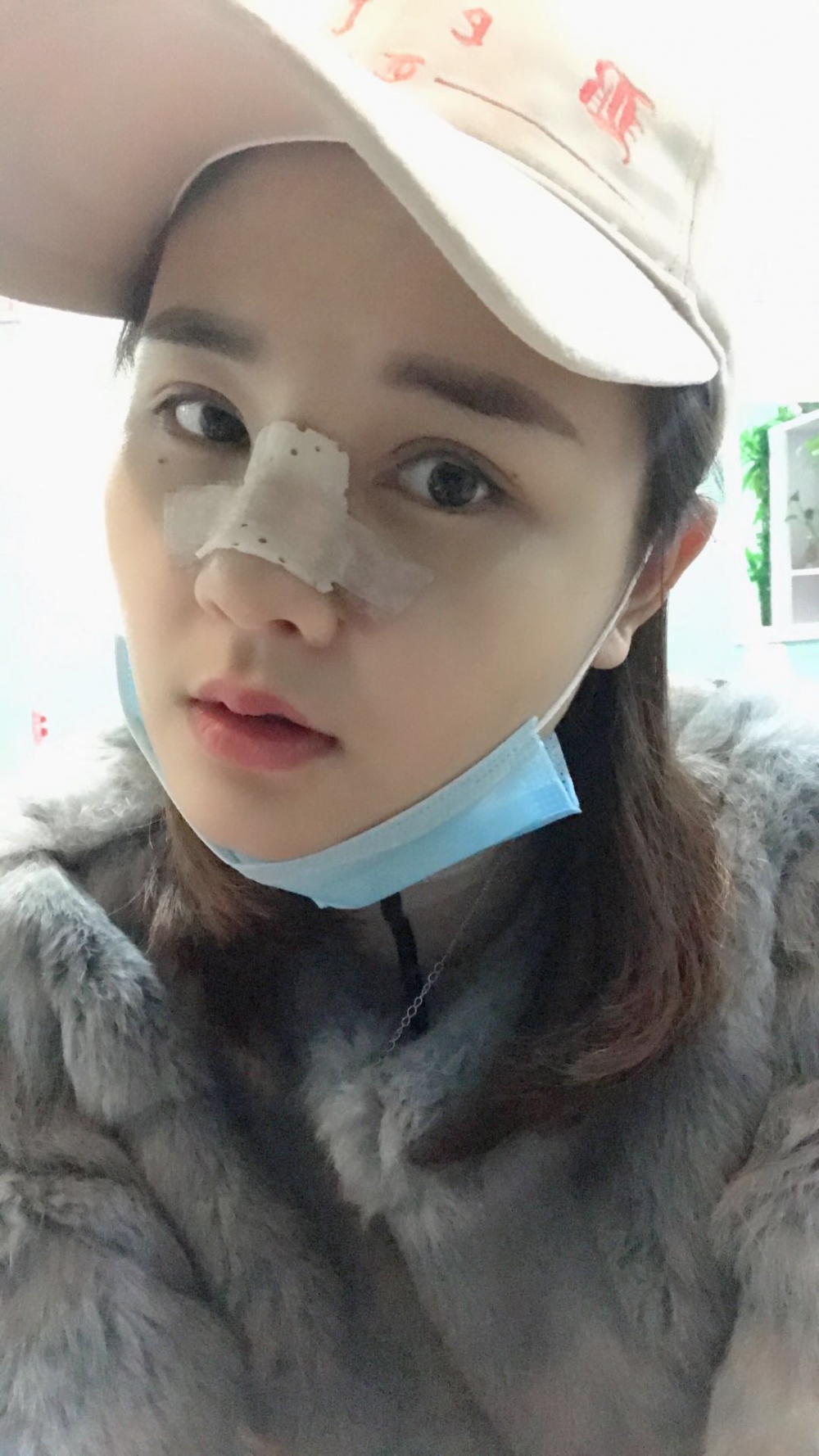 鄭州華領醫(yī)療美容醫(yī)院賀小虎醫(yī)生做眼綜合+鼻部整形手術效果怎么樣？