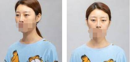 太原歐美蓮整形醫(yī)院丁曉峰醫(yī)生做雙眼皮怎么樣？丁曉峰雙眼皮手術(shù)案例分享