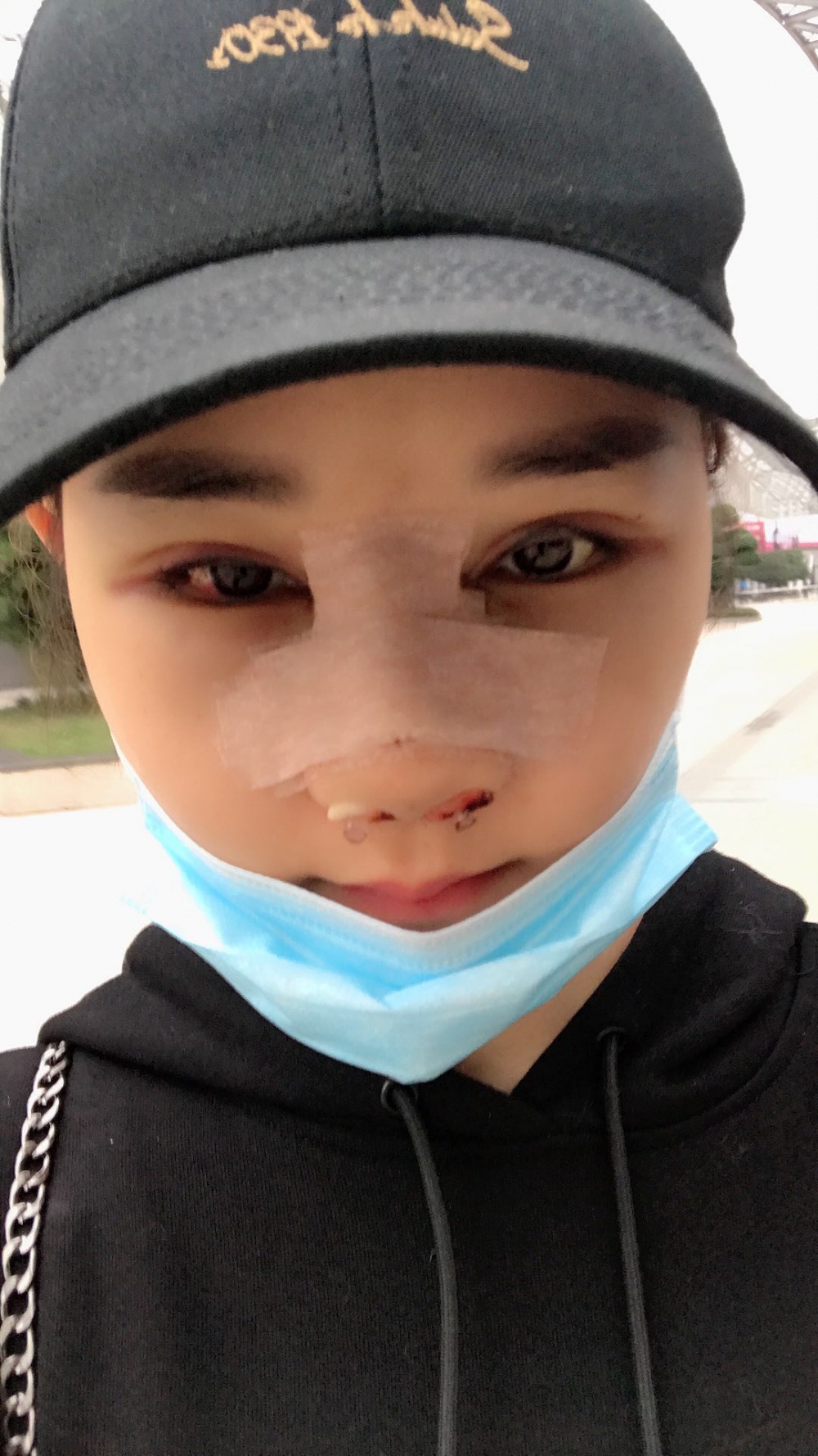 鄭州華領醫(yī)療美容醫(yī)院賀小虎醫(yī)生做眼綜合+鼻部整形手術效果怎么樣？