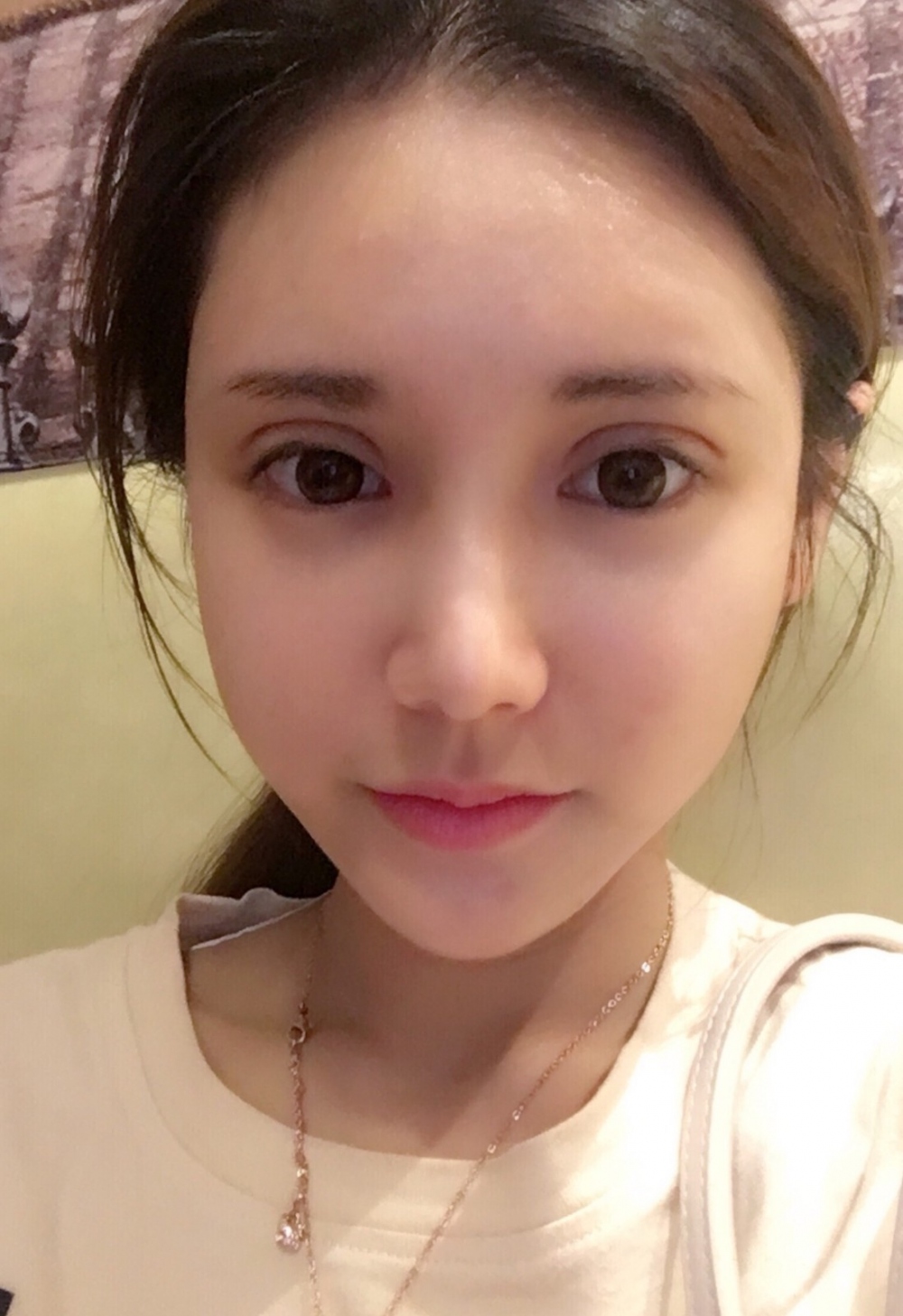 鄭州銘藝整形醫(yī)生陳濤做切開雙眼皮怎么樣？鄭州銘藝切開雙眼皮案例
