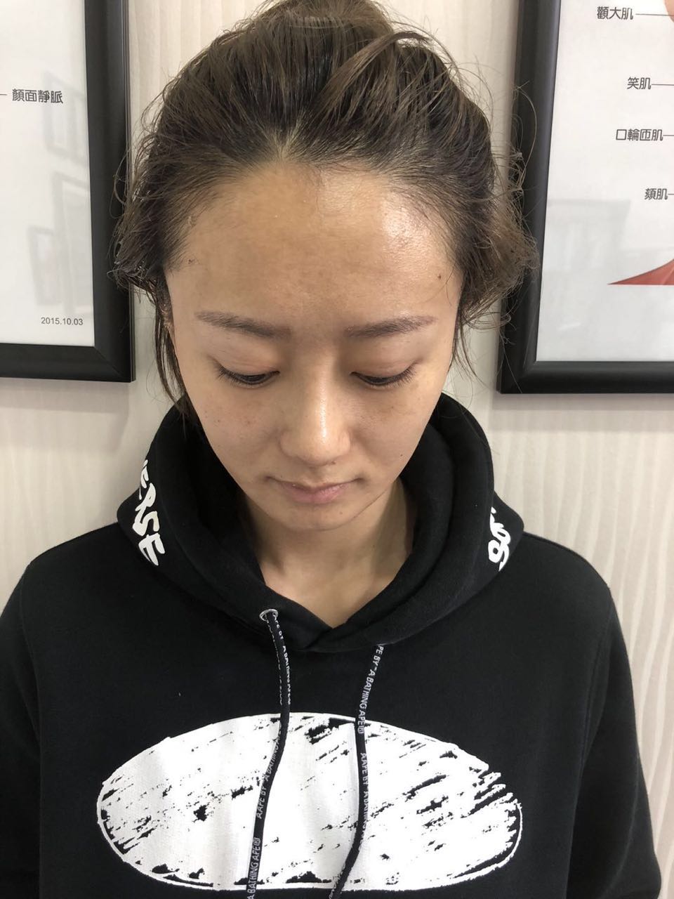 杭州迪美整形常德成醫(yī)生做鼻綜合整形技術(shù)怎么樣？附鼻綜合整形案例