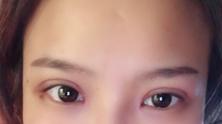 長春麥西美嘉整形醫(yī)生王圣博做雙眼皮手術(shù)效果怎么樣？附雙眼皮案例