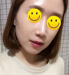 信陽東方藝美容醫(yī)院劉力萌做玻尿酸去法令紋效果怎么樣？附案例效果對(duì)比圖