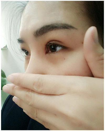 營口臻美醫(yī)療整形醫(yī)生閆迎軍做雙眼皮效果怎么樣？附雙眼皮案例對比圖