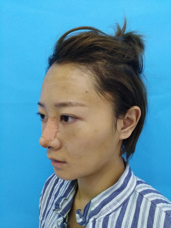 杭州迪美整形常德成醫(yī)生做鼻綜合整形技術(shù)怎么樣？附鼻綜合整形案例