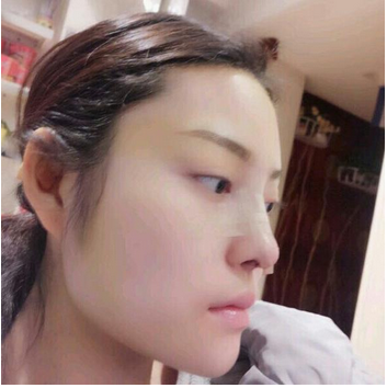 武漢維納斯整形醫(yī)院韓國濤醫(yī)生做鼻綜合整形怎么樣？附鼻綜合整形案例