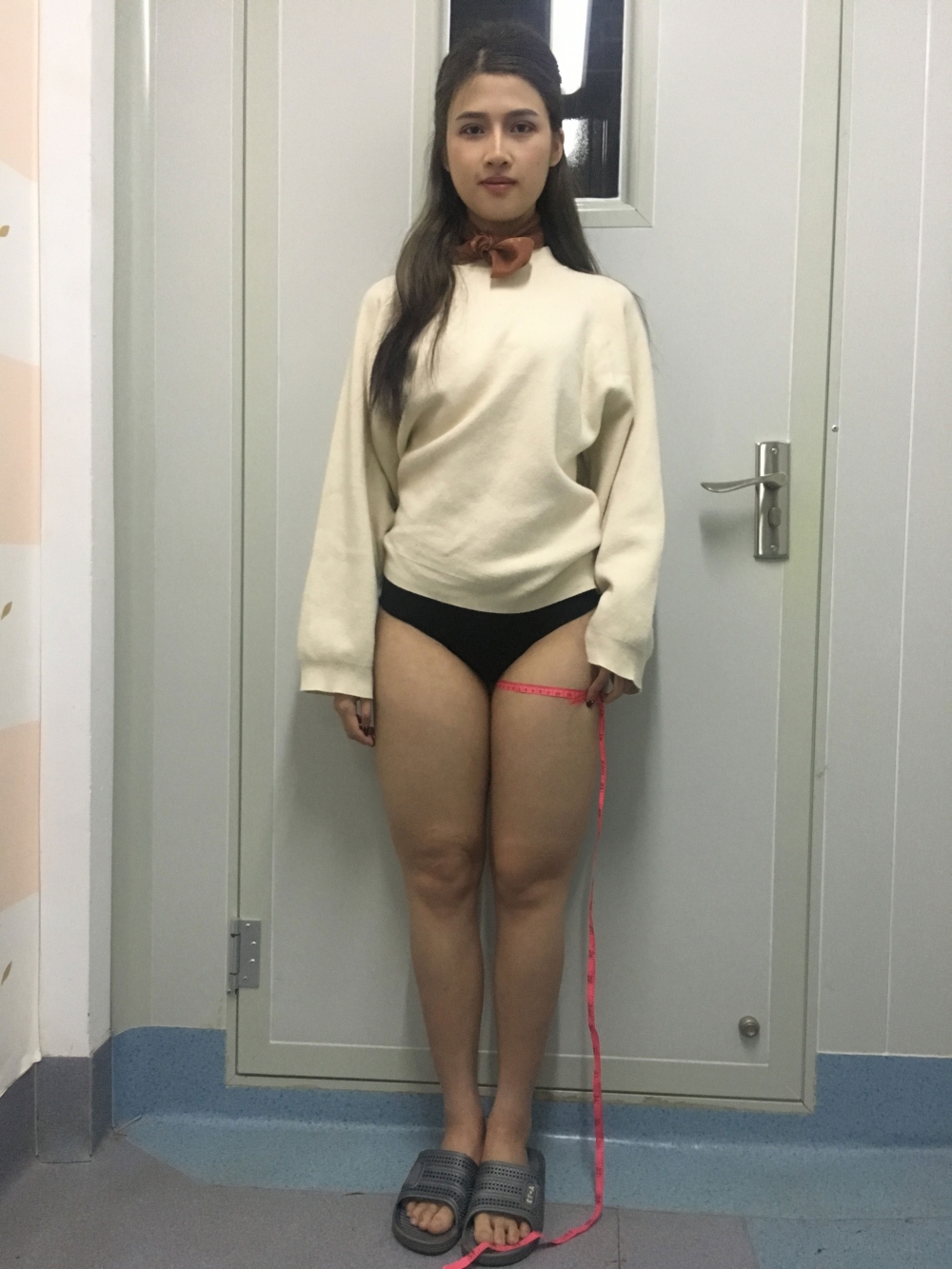 晉城鳳凰整形美容醫(yī)院宋發(fā)興醫(yī)生做大腿吸脂怎么樣？附大腿吸脂案例