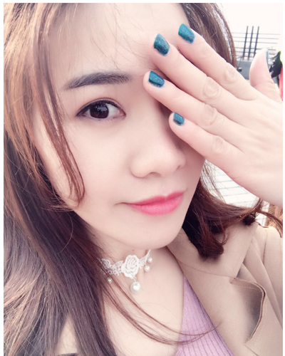 營口臻美醫(yī)療整形醫(yī)生閆迎軍做雙眼皮效果怎么樣？附雙眼皮案例對比圖