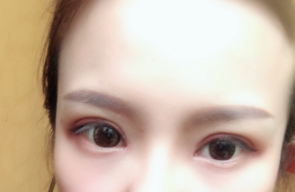 長春麥西美嘉整形醫(yī)生王圣博做雙眼皮手術(shù)效果怎么樣？附雙眼皮案例
