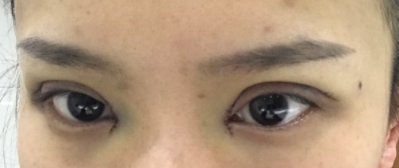 長春麥西美嘉整形醫(yī)生王圣博做雙眼皮手術(shù)效果怎么樣？附雙眼皮案例