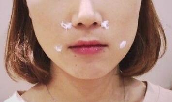 信陽東方藝美容醫(yī)院劉力萌做玻尿酸去法令紋效果怎么樣？附案例效果對比圖