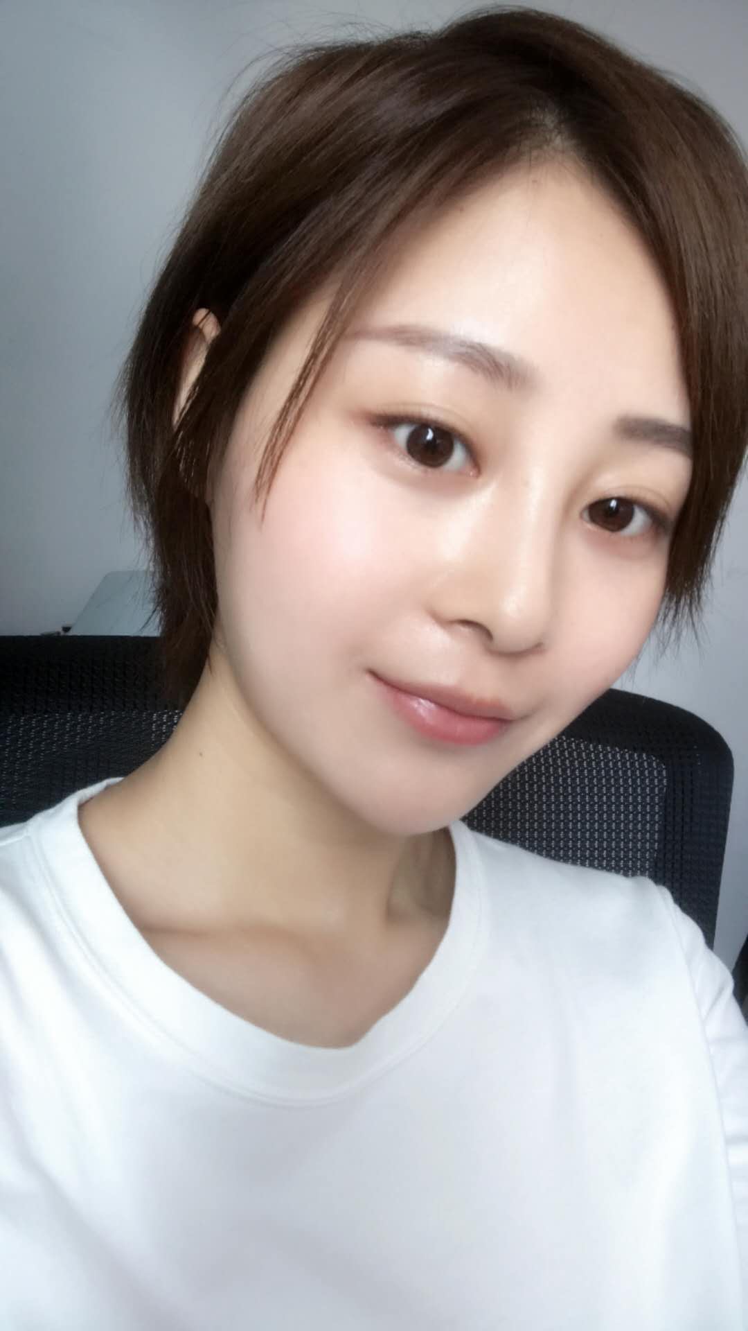 天津歐華威莎整形醫(yī)生姚玲做面部埋線提升效果怎么樣？附埋線提升案例
