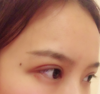 長春麥西美嘉整形醫(yī)生王圣博做雙眼皮手術(shù)效果怎么樣？附雙眼皮案例