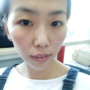 珠海蒂伊醫(yī)療整形醫(yī)生廖俊凱做激光祛斑效果怎么樣？附激光祛斑案例效果圖