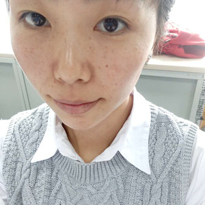 珠海蒂伊醫(yī)療整形醫(yī)生廖俊凱做激光祛斑效果怎么樣？附激光祛斑案例效果圖