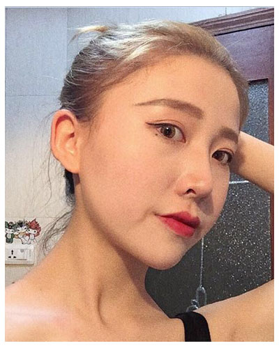 珠海海大整形美容外科黃發(fā)醫(yī)生做面部吸脂怎么樣？附面部吸脂案例