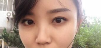 長沙微笑醫(yī)療整形醫(yī)生段雙軍做切開雙眼皮+開內(nèi)眼角效果怎么樣？附案例