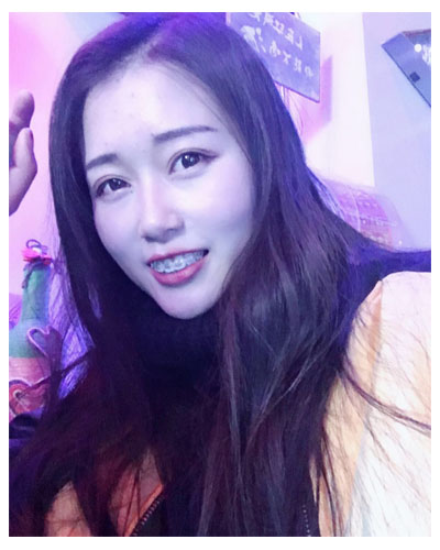 義烏傅氏口腔醫(yī)生朱雨晴做牙齒隱形矯正效果怎么樣？附牙齒隱形矯正案例