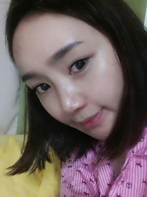 長春中妍整形醫(yī)院吳學(xué)軍醫(yī)生做玻尿酸墊下巴+玻尿酸豐太陽穴案例效果對比圖
